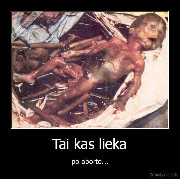 abortas, durnes, kurios, pasidaro, vaikai, gali, isgyvent