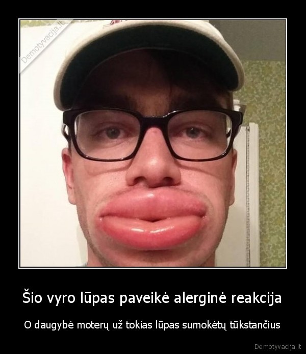 botoksas,alergija,storos, lupos