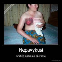 Nepavykusi - Krūties mažinimo operacija